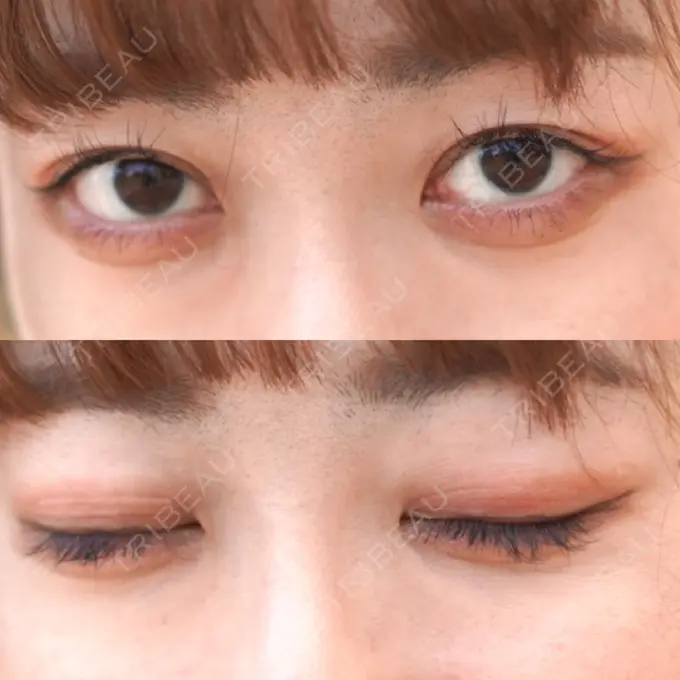 二重埋没 東京イセアクリニック BEFORE メイン用