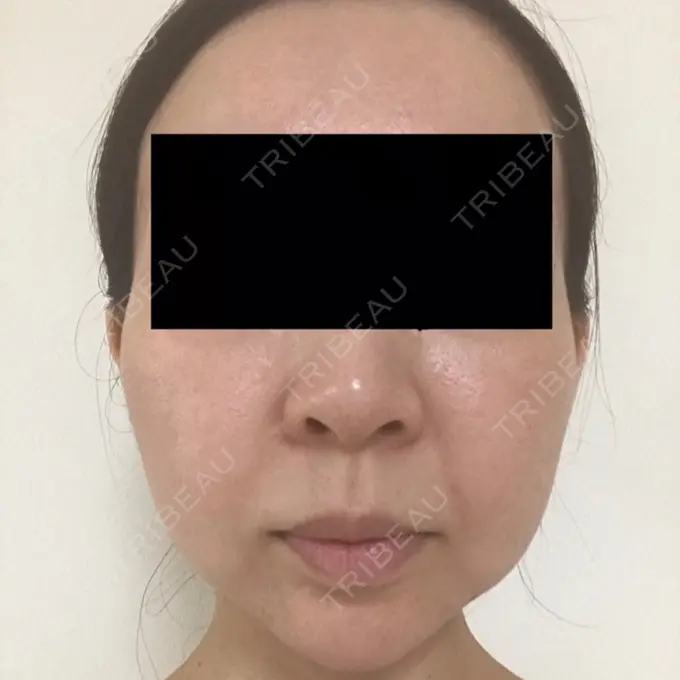 脂肪吸引（顔） GRACIA clinic 【グラシアクリニック】 BEFORE メイン用