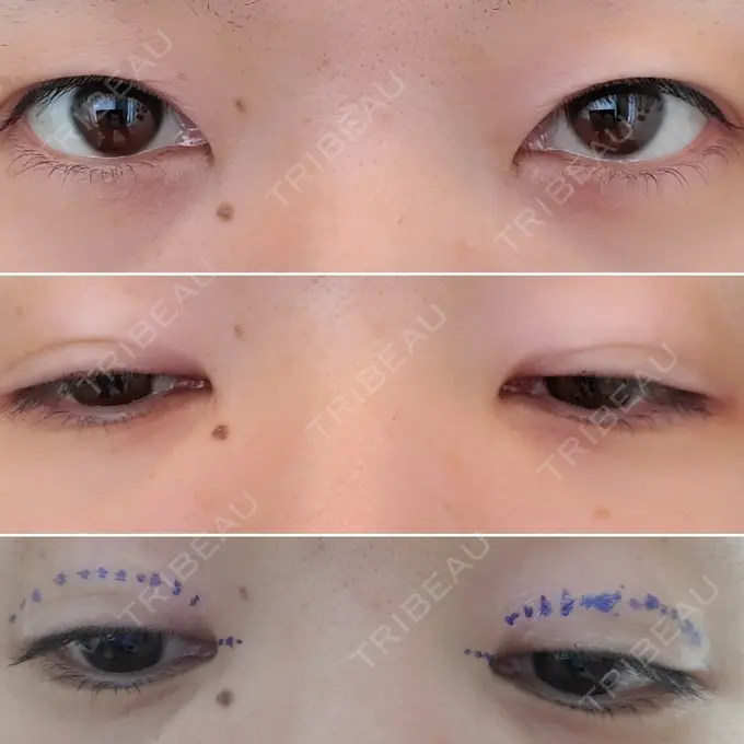 二重埋没 / 目頭切開 / その他 湘南美容クリニック 京都院 BEFORE メイン用