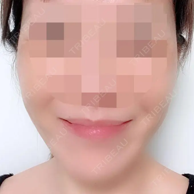 骨切り（あご） / 骨削り（エラ） / 骨削り（頬） シンデレラ美容整形外科 BEFORE メイン用