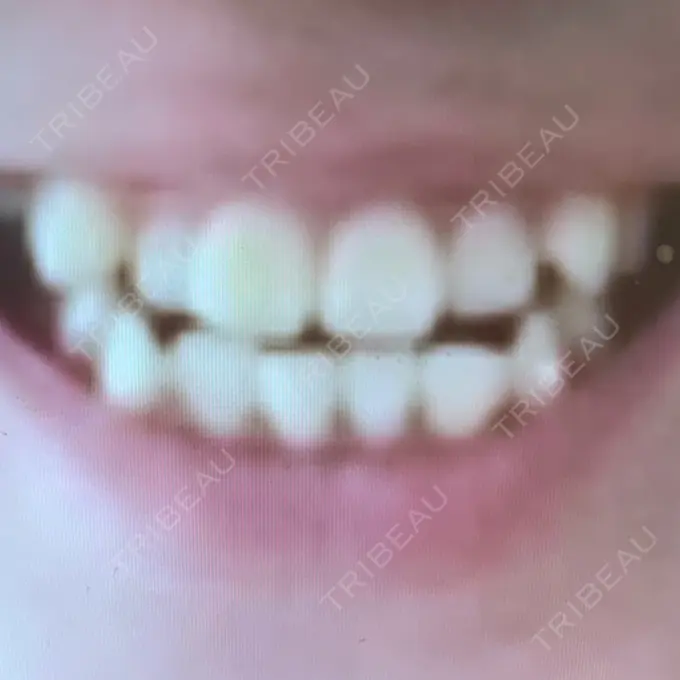 矯正（ワイヤー） ランバート矯正歯科 BEFORE メイン用