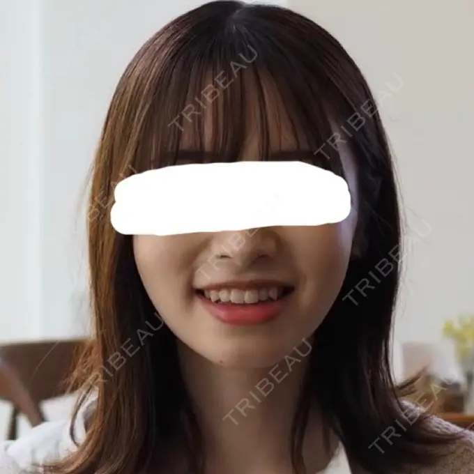 脂肪溶解注射（顔） 赤坂プレミアクリニック BEFORE メイン用