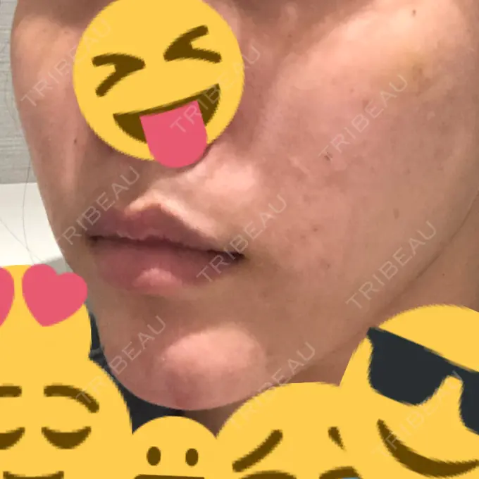 ルフォー+ssro（両あご) / 輪郭修正 ウォンジン（Wonjin）整形外科 BEFORE メイン用