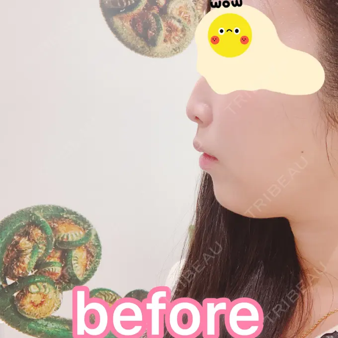 ヒアルロン酸注入（鼻） / ヒアルロン酸注入（あご） / ヒアルロン酸注入（唇） BIANCA銀座 BEFORE メイン用