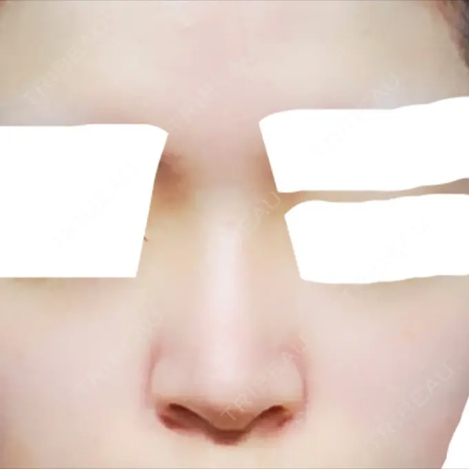 隆鼻術 / 軟骨移植 / プロテーゼ除去 FROM B整形外科 (旧バウム整形外科) BEFORE メイン用