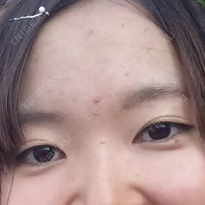 二重切開 ジョウクリニック 高知院 BEFORE メイン用