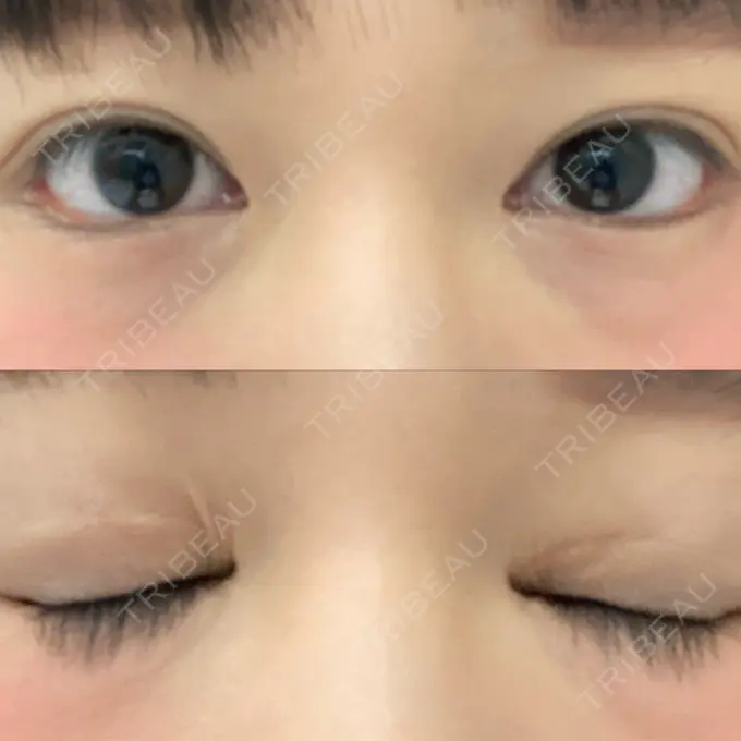 蒙古ひだ形成 / 目元修正 銀座高須クリニック BEFORE メイン用