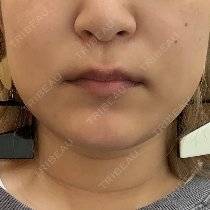 糸リフト / 脂肪溶解注射（顔） 品川スキンクリニック 新潟院 BEFORE メイン用