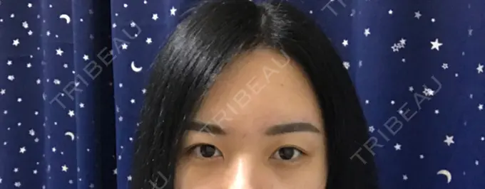 二重切開 / 目頭切開 / 目尻切開 / その他（目元） DI（ディアイ）整形外科 BEFORE メイン用