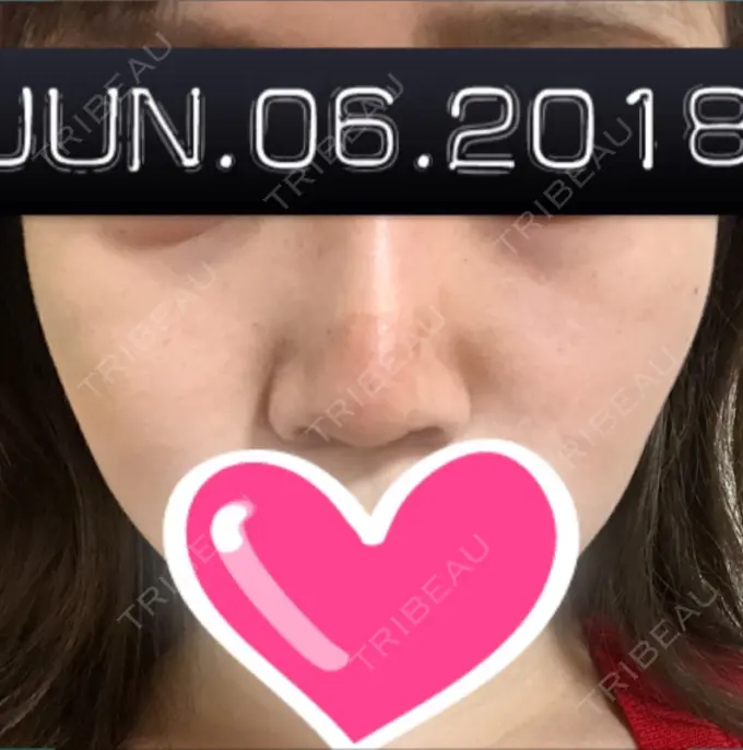 隆鼻術 / 鼻中隔延長（切開） / 軟骨移植 ジュエリー美容外科 BEFORE メイン用