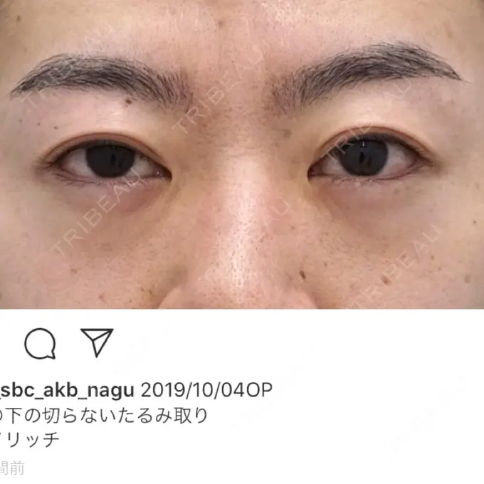 下まぶたたるみ取り / 下まぶたの脂肪取り / 脂肪注入（肌） 湘南美容クリニック 秋葉原院 BEFORE メイン用