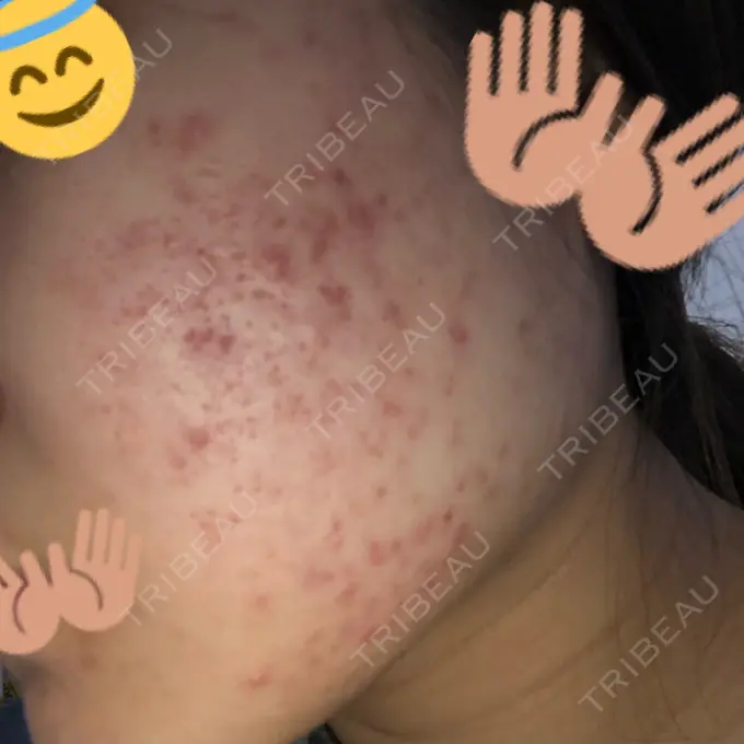 ピーリング（ニキビ・毛穴） / イオン導入 / エレクトロポレーション 湘南美容クリニック 宇都宮院 BEFORE メイン用