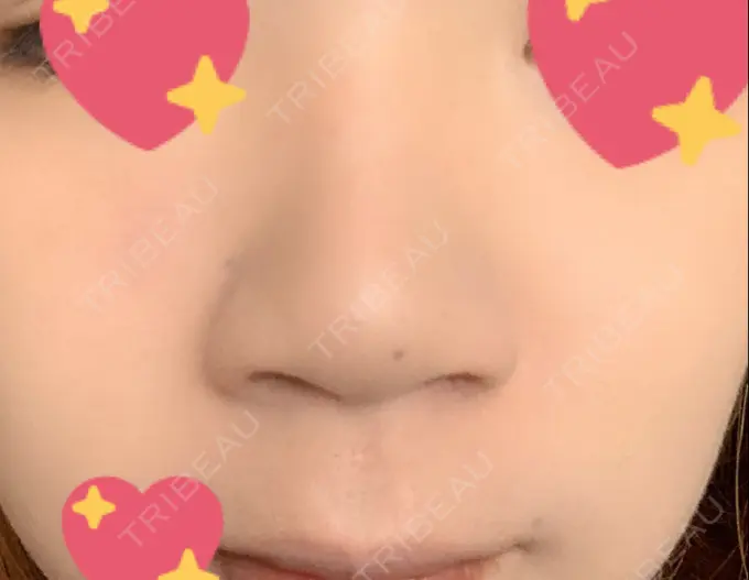 鼻尖形成（切開） / 小鼻縮小（切開） / 軟骨移植 もとび美容外科クリニック 新宿院 BEFORE メイン用