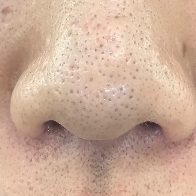 鼻尖形成（切開） 水の森美容クリニック 名古屋院 BEFORE メイン用