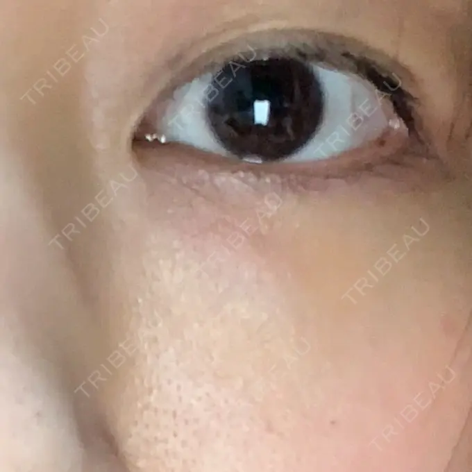 ヒアルロン酸溶解 湘南美容クリニック 大阪京橋院 BEFORE メイン用