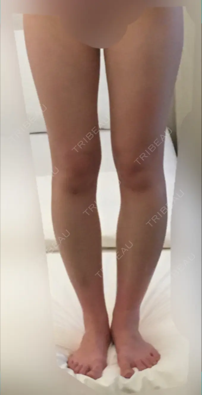 脂肪吸引（脚） / 脂肪吸引（お尻） ドクターフィット（Dr.fit）クリニック BEFORE メイン用