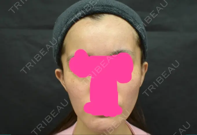 こめかみ形成 / ヒアルロン酸注入（額） / ヒアルロン酸注入（頬） ジョウクリニック 大阪院 BEFORE メイン用