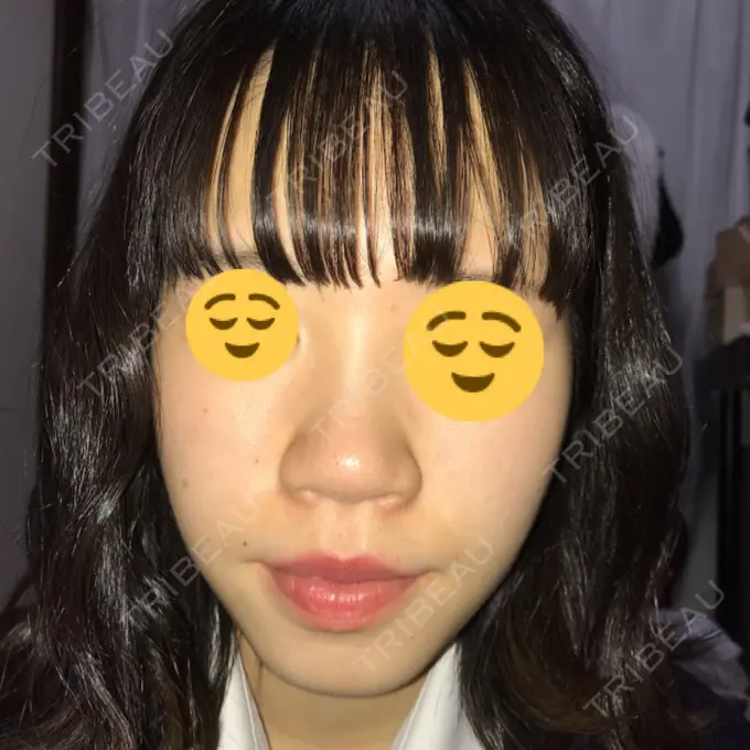 毛穴洗浄（ハイドラフェイシャルなど） 神成（こうせい）美容外科 BEFORE メイン用