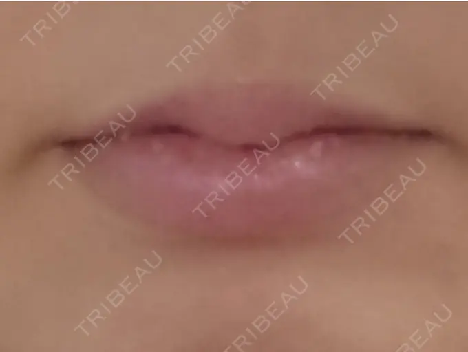 口角挙上 / その他（口元） 現代美学整形外科 BEFORE メイン用