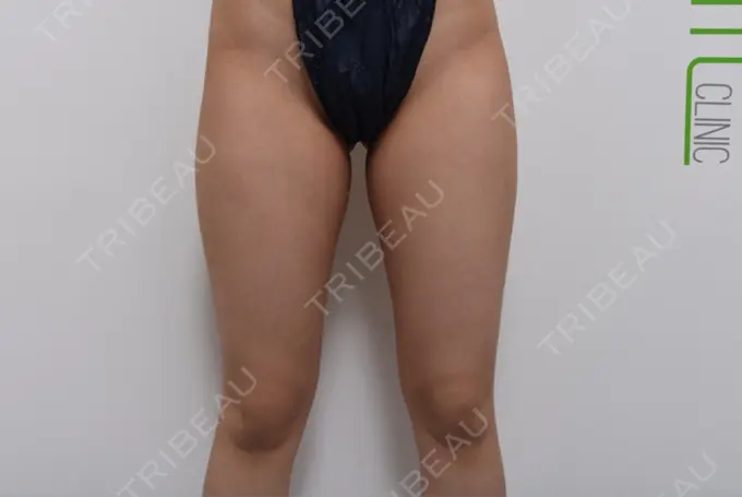 脂肪吸引（脚） / 豊胸（脂肪注入） ドクターフィット（Dr.fit）クリニック BEFORE メイン用