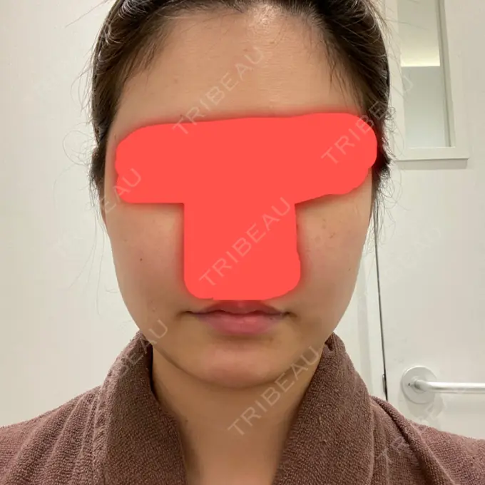 脂肪吸引（顔） / ボトックス（エラ・小顔） / 美容点滴・美容注射（美肌） エートップ美容整形外科 BEFORE メイン用