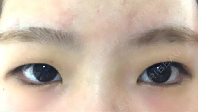 二重切開 きくな湯田眼科 BEFORE メイン用