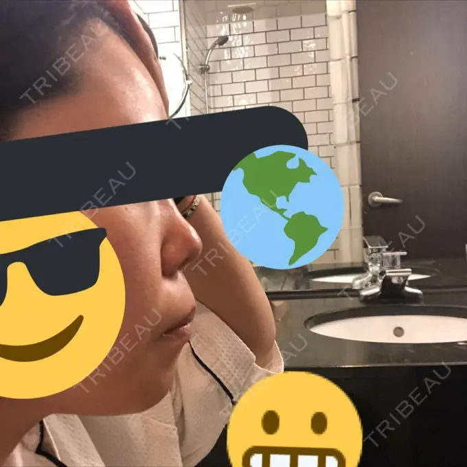 隆鼻術 / 鼻尖形成（切開） / 鼻中隔延長（切開） / 眉間プロテーゼ FROM B整形外科 (旧バウム整形外科) BEFORE メイン用