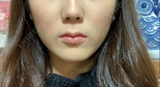 脂肪溶解注射（顔） 赤坂プレミアクリニック BEFORE メイン用