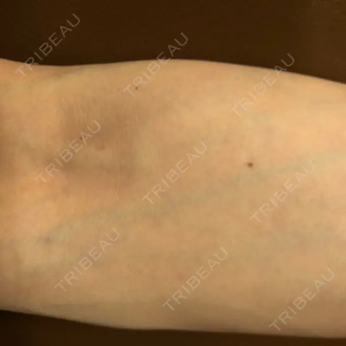 美容点滴・美容注射（美肌） 秋葉原スキンクリニック BEFORE メイン用