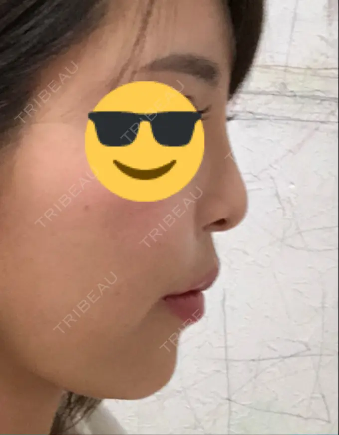 隆鼻術 / 鼻中隔延長（切開） / 軟骨移植 / 骨切幅寄せ / プロテーゼ除去 / 鼻修正 / 真皮移植 / 鼻孔縁下降 KOKO整形外科 BEFORE メイン用