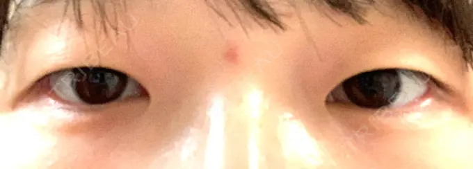 二重埋没 湘南美容クリニック 東京蒲田院 BEFORE メイン用