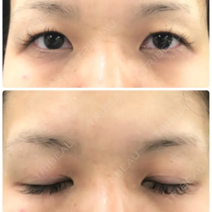 二重切開 / 目元修正 きくな湯田眼科 BEFORE メイン用