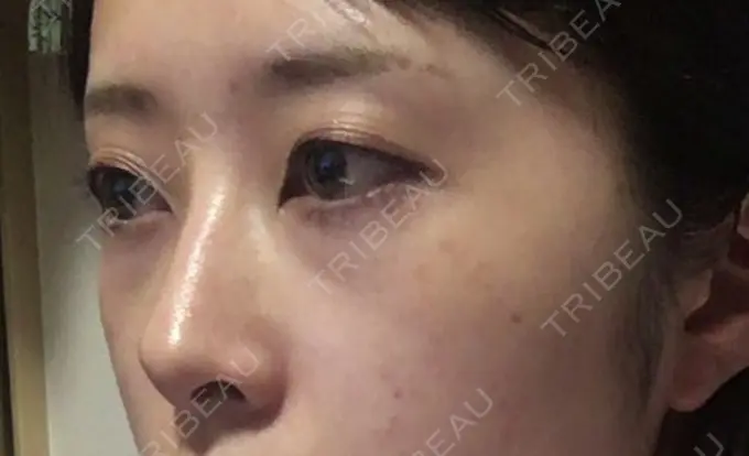 クマ治療 プラストクリニック BEFORE メイン用