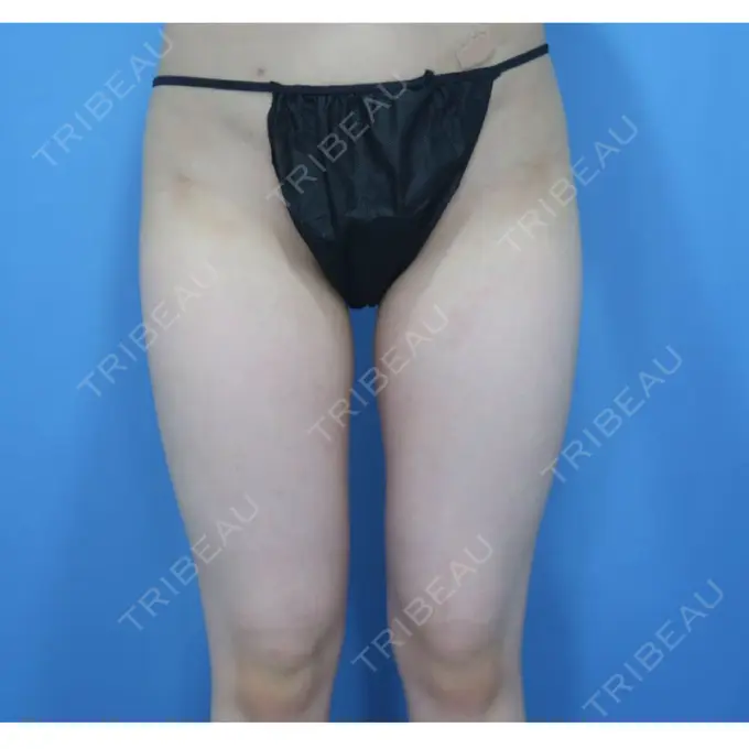 脂肪吸引（脚） / その他（ボディ） ラインカルチャークリニック BEFORE メイン用