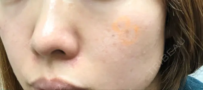 イオン導入 / 美肌レーザー / シミ取りレーザー / エレクトロポレーション 湘南美容クリニック 秋葉原院 BEFORE メイン用