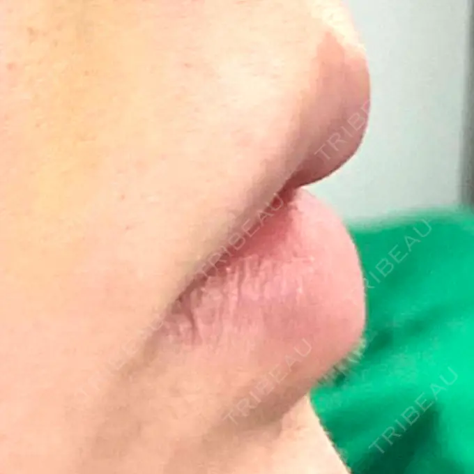 口角挙上 現代美学整形外科 BEFORE メイン用