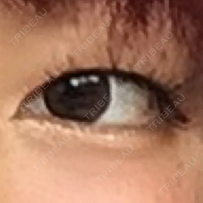 二重埋没 湘南美容クリニック 京都院 BEFORE メイン用