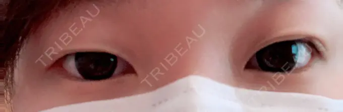 二重埋没 湘南美容クリニック 京都院 BEFORE メイン用