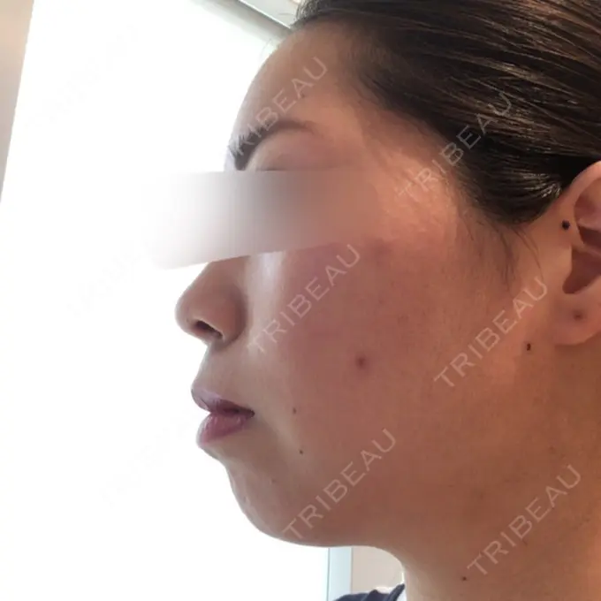 ボトックス（エラ・小顔） Wクリニック 心斎橋院 BEFORE メイン用