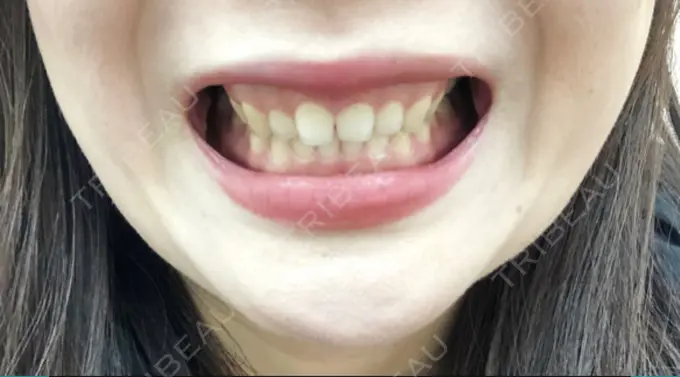 その他（審美歯科/矯正歯科） 南青山矯正歯科 BEFORE メイン用