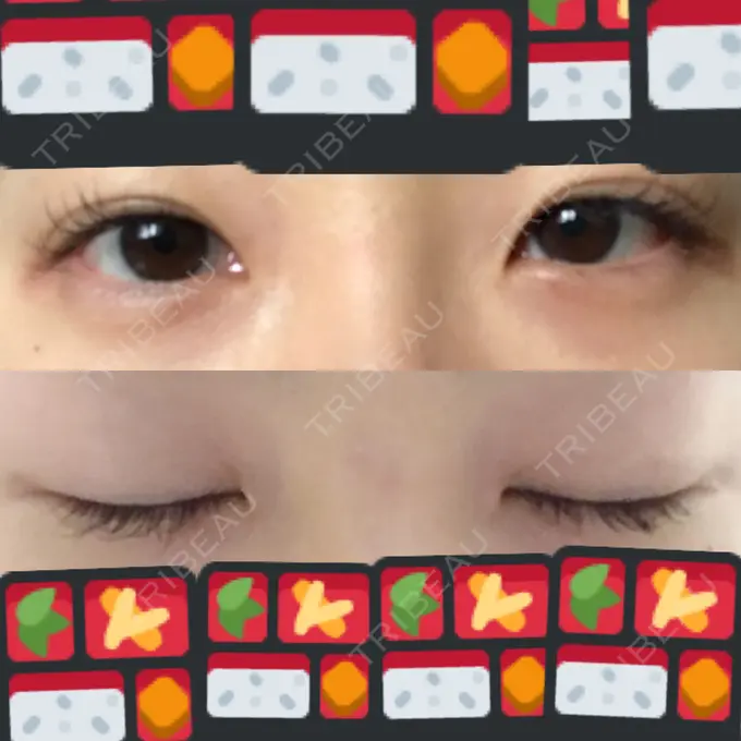 二重埋没 湘南美容クリニック 東京蒲田院 BEFORE メイン用