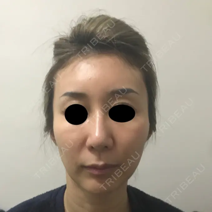 糸リフト / 額を丸く / 人中短縮 / こめかみ形成 / ヒアルロン酸注入（あご） / ボトックス（エラ・小顔） / ヒアルロン酸注入（頬） あきこクリニック BEFORE メイン用