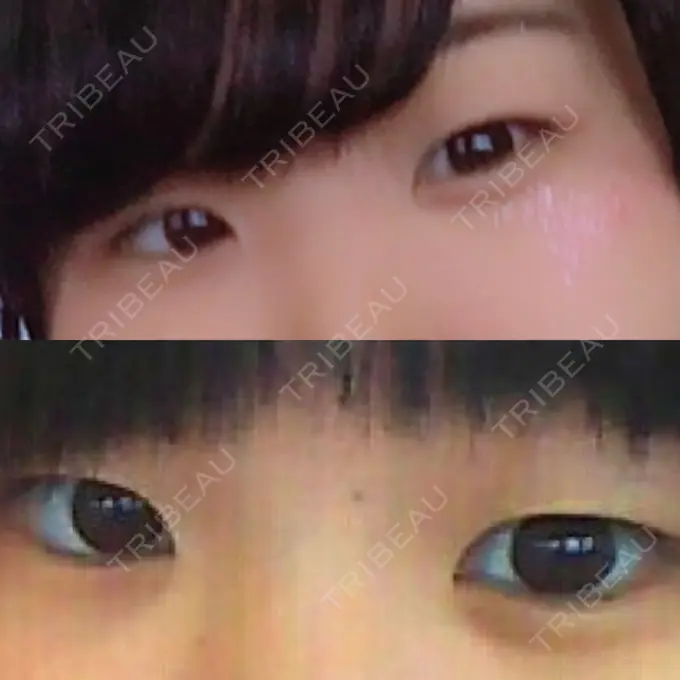 二重埋没 湘南美容クリニック 東京蒲田院 BEFORE メイン用