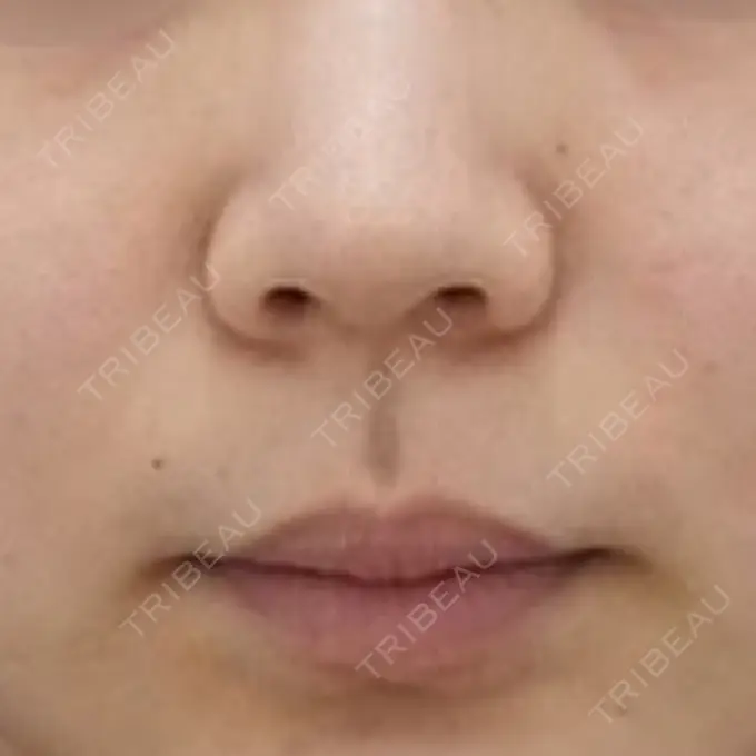 小鼻縮小（切開） / 鼻翼挙上 / 鼻孔縁挙上 大阪TAクリニック BEFORE メイン用