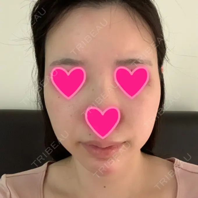 あごプロテーゼ / 骨切り（あご） / 骨削り（エラ） / 骨削り（頬） View美容整形外科 BEFORE メイン用