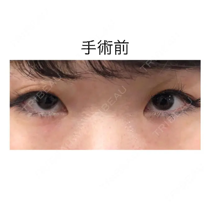 二重切開 / 目頭切開 / 眼瞼下垂（切開） / 目尻切開 / タレ目形成・グラマラスライン（切開） ジュエリー美容外科 BEFORE メイン用