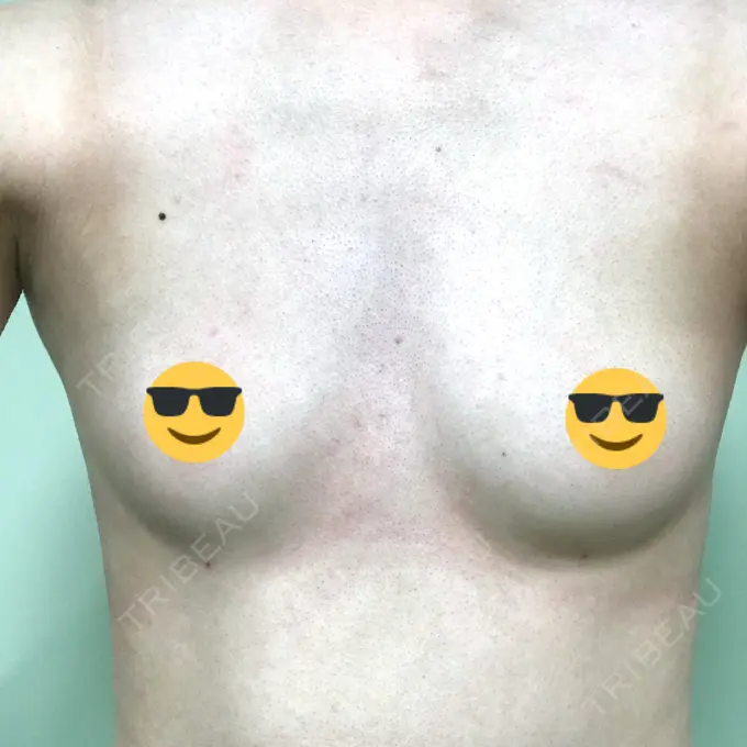 脂肪吸引（脚） / 豊胸（脂肪注入） THE CLINIC（ザ・クリニック） 名古屋院 BEFORE メイン用