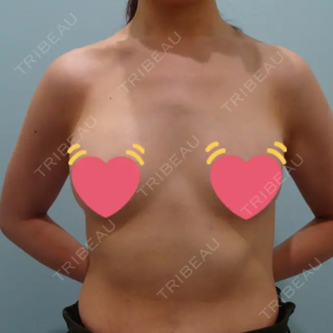 豊胸（ヒアルロン酸） WOM CLINIC GINZA （ワム クリニック ギンザ） BEFORE メイン用