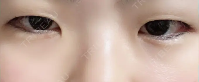 二重埋没 城本クリニック 豊橋院 BEFORE メイン用