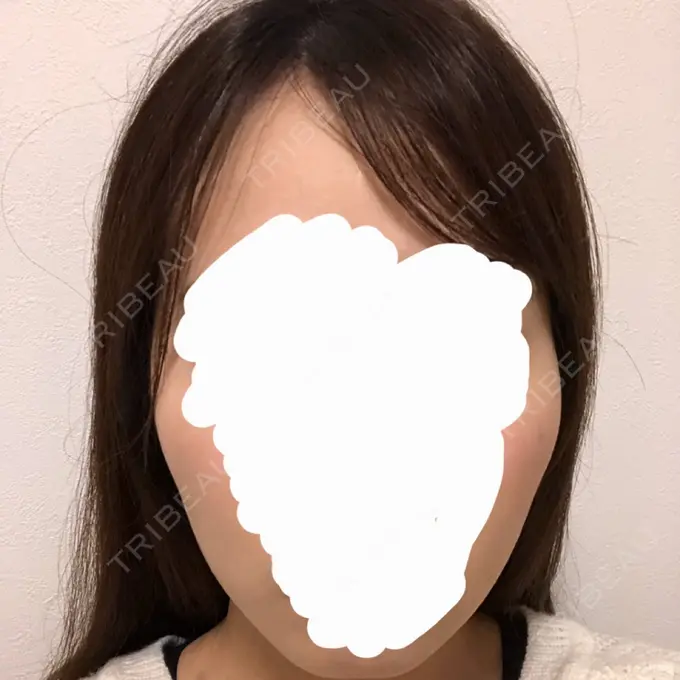 骨削り（頬） RG整形外科（旧リオン整形外科） BEFORE メイン用